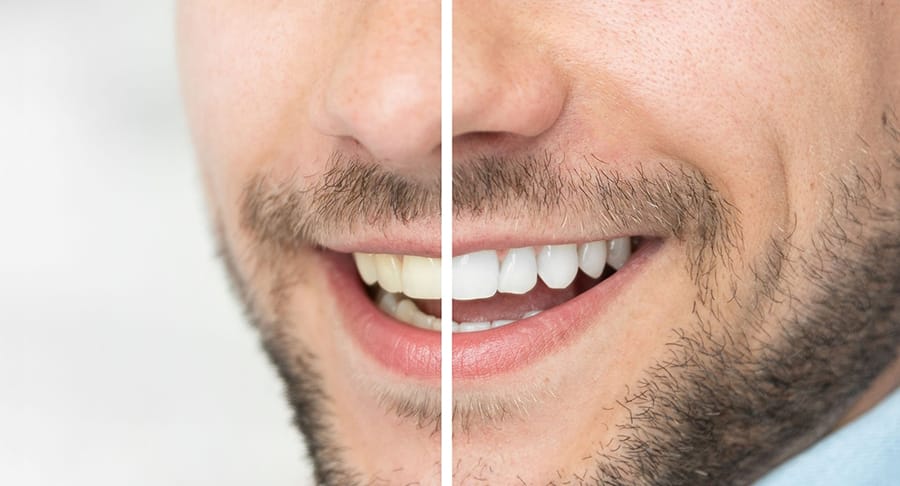 Wybielanie Zębów Kielce - Efekt Przed I Po